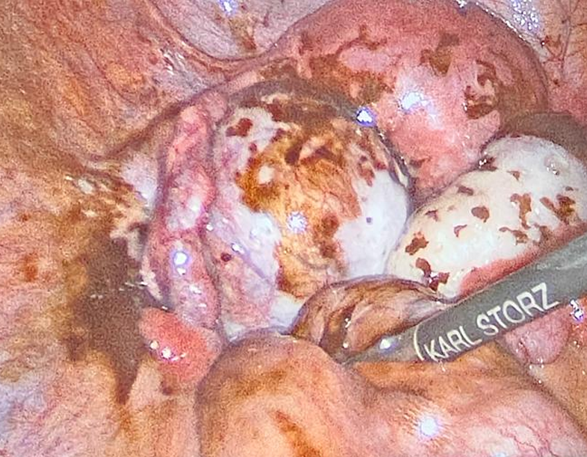 Tratamiento quirúrgico de Endometriosis  