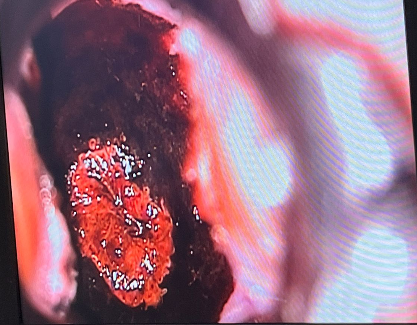 Detección y tratamiento por lesiones de Virus de Papiloma Humano 